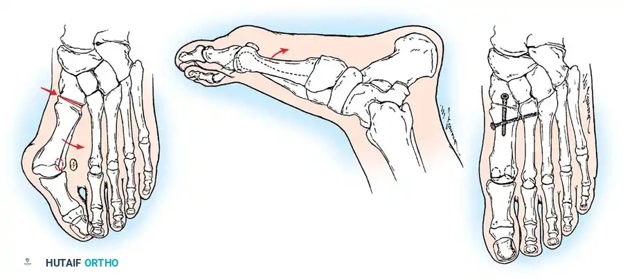 Disorders of the Hallux Surgical Diagram