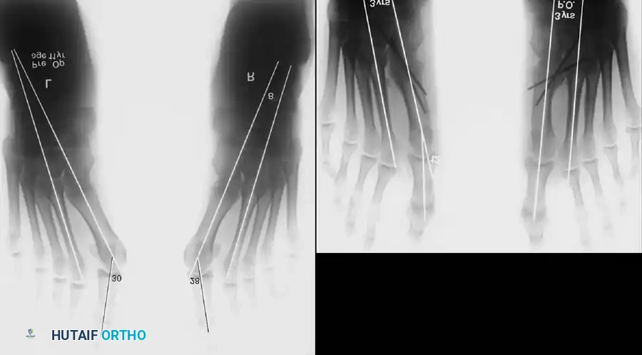 Disorders of the Hallux Surgical Diagram