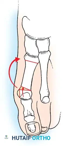 Disorders of the Hallux Surgical Diagram
