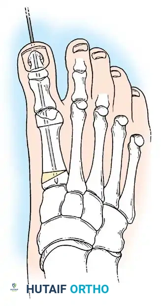 Fig. 78-63 Intramedullary ﬁ xation with Steinmann pin secures longitudinal alignment of metatarsal and both phalanges.