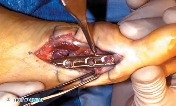 Disorders of the Hallux Surgical Diagram
