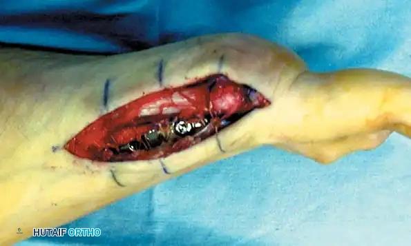 Disorders of the Hallux Surgical Diagram