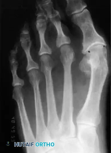 Disorders of the Hallux Surgical Diagram