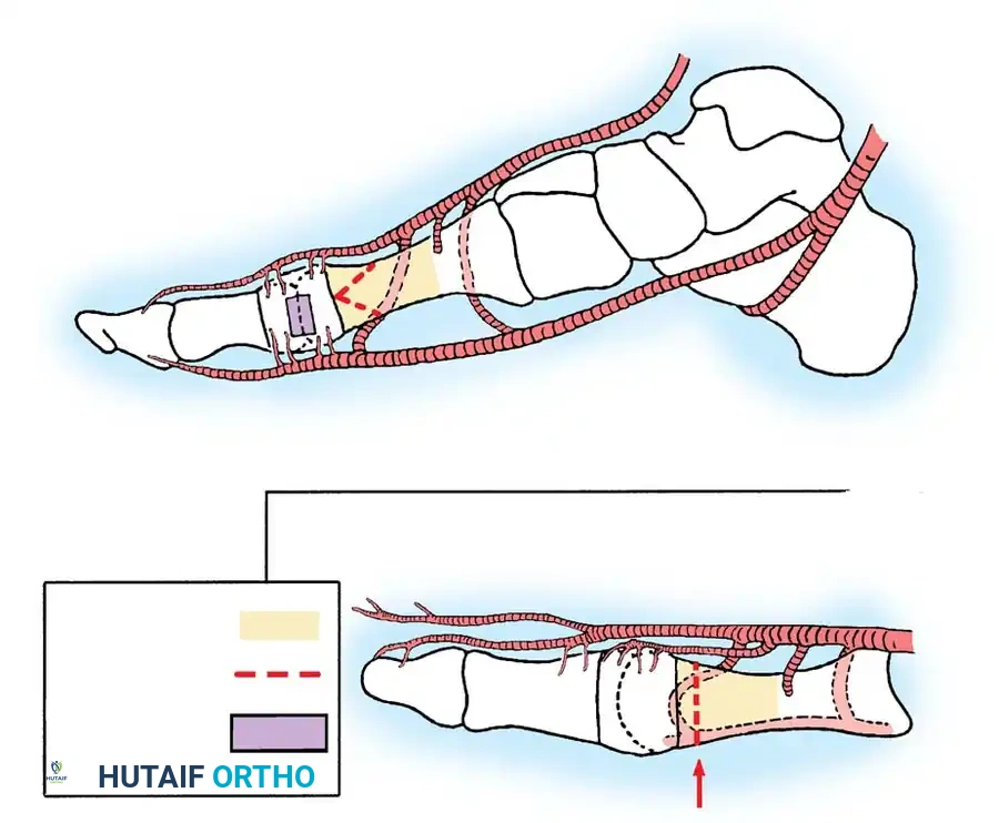 Safe zones—Dorsal view