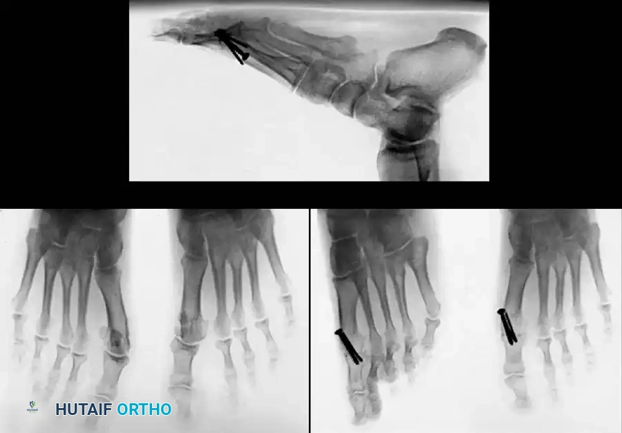 Disorders of the Hallux Surgical Diagram