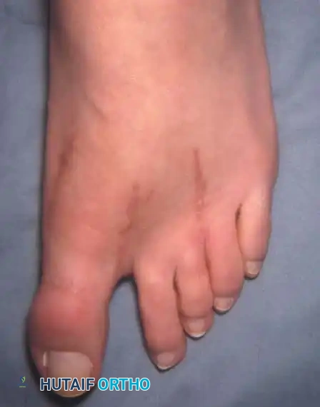 Fig. 78-72 A, Fixed hallux varus after McBride bunionectomy. B, Hallux varus after McBride bunionectomy with ﬁ bular sesamoid excision. Removing ﬁ bular sesamoid removes valgusproducing moments of adductor hallucis and ﬂ exor hallucis brevis (lateral head) muscles.