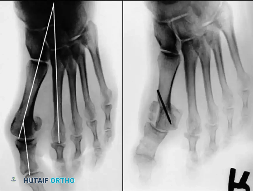 Disorders of the Hallux Surgical Diagram
