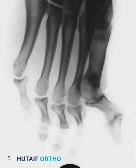 Disorders of the Hallux Surgical Diagram