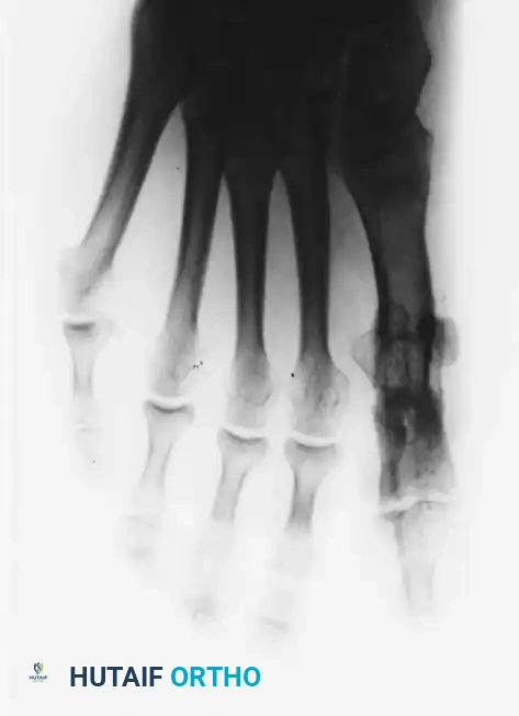Fig. 78-75 A and B, Hyperextension of metatarsophalangeal joint and hyperﬂ exion of interphalangeal joint, in addition to varus and rotation of hallux. C and D, Dynamic (supple) deformity treated by arthrodesis of ﬁ rst metatarsophalangeal joint and plantar release of interphalangeal joint.