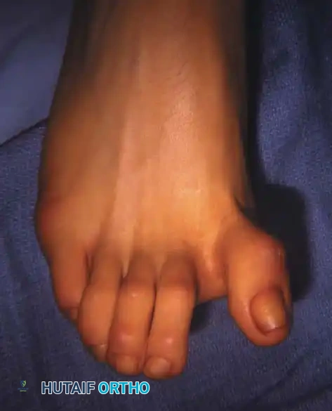 Fig. 78-75 A and B, Hyperextension of metatarsophalangeal joint and hyperﬂ exion of interphalangeal joint, in addition to varus and rotation of hallux. C and D, Dynamic (supple) deformity treated by arthrodesis of ﬁ rst metatarsophalangeal joint and plantar release of interphalangeal joint.