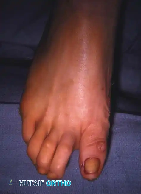 Fig. 78-75 A and B, Hyperextension of metatarsophalangeal joint and hyperﬂ exion of interphalangeal joint, in addition to varus and rotation of hallux. C and D, Dynamic (supple) deformity treated by arthrodesis of ﬁ rst metatarsophalangeal joint and plantar release of interphalangeal joint.