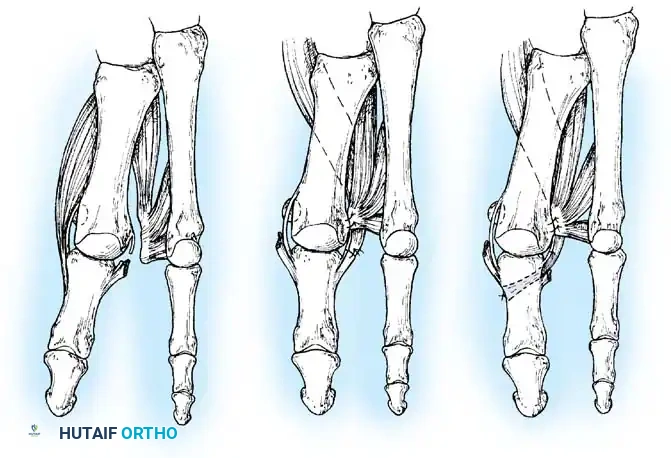 Disorders of the Hallux Surgical Diagram