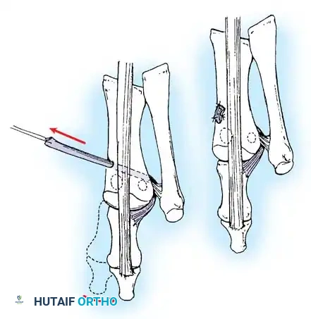Disorders of the Hallux Surgical Diagram