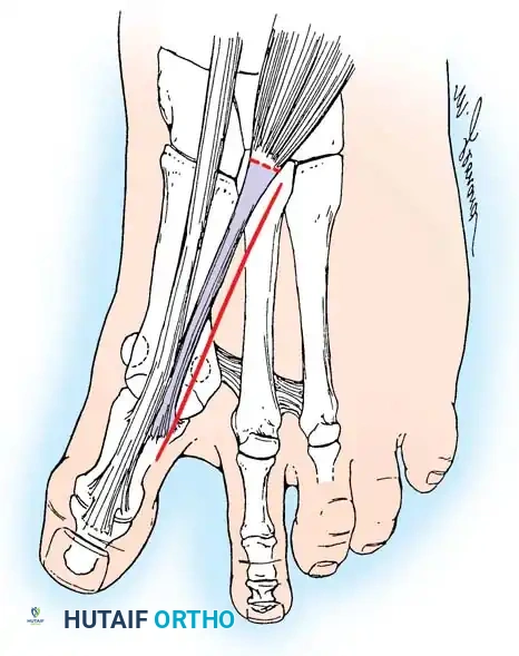 Disorders of the Hallux Surgical Diagram