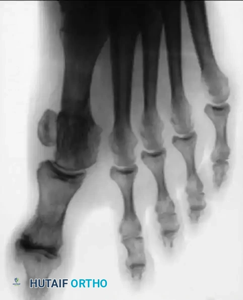 Disorders of the Hallux Surgical Diagram