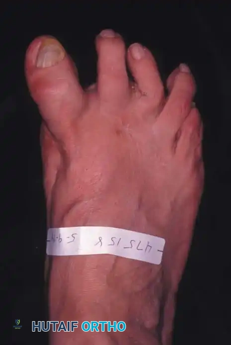 Fig. 78-82 Dorsomedial subluxation of hallux after ﬁ bular sesamoidectomy, medial capsular imbrication, and displacement of tibial sesamoid medially.