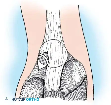 DISORDERS OF THE PATELLA Surgical Diagram