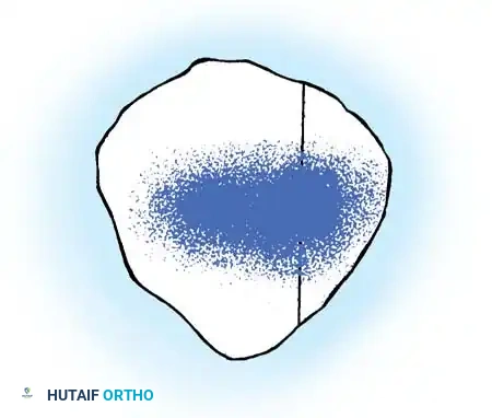 DISORDERS OF THE PATELLA Surgical Diagram