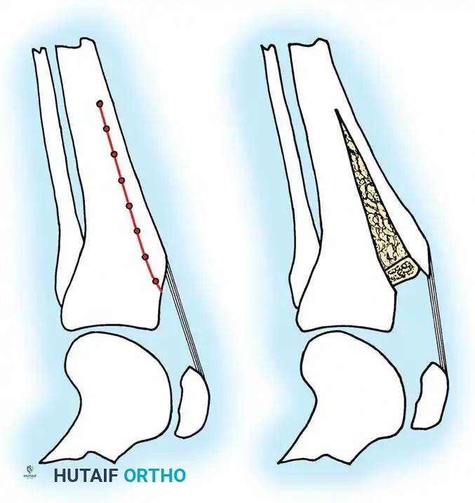DISORDERS OF THE PATELLA Surgical Diagram