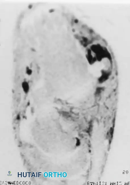 Fig. 85-31 A and B, Radiographs of patient with bony avulsion of peroneus longus sesamoid bone. C, MRI (T2 weighted) of type I tear of both peroneus longus and peroneus brevis tendons. Peroneus brevis disease was best seen at inferior aspect of lateral malleolus, and peroneus longus disease was best seen at lateral border of foot near cuboid groove.