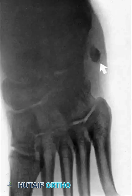 DISORDERS OF THE PERONEAL TENDONS Surgical Diagram