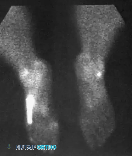 DISORDERS OF THE PERONEAL TENDONS Surgical Diagram