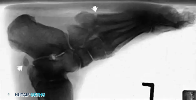 DISORDERS OF THE PERONEAL TENDONS Surgical Diagram