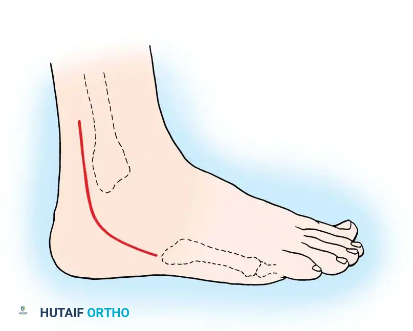 Fig. 85-33 Incision for tenosynovectomy for tear of peroneal tendons.