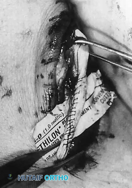 Fig. 85-36 Tubularized peroneus brevis tendon after débridement and repair. (From Yodlowski ML, Mizel MS: Reconstruction of peroneus brevis pathology, Oper Tech Orthop Surg 4:150, 1994.)