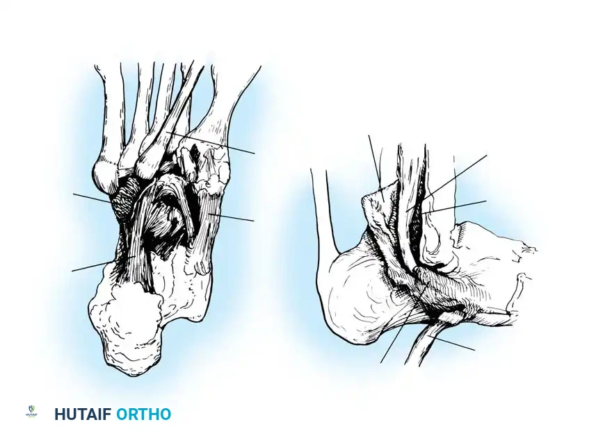 DISORDERS OF THE PERONEAL TENDONS Surgical Diagram