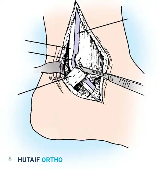 DISORDERS OF THE PERONEAL TENDONS Surgical Diagram