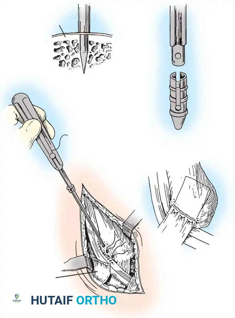 DISORDERS OF THE PERONEAL TENDONS Surgical Diagram