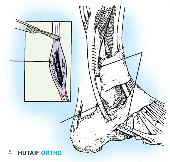 DISORDERS OF THE PERONEAL TENDONS Surgical Diagram