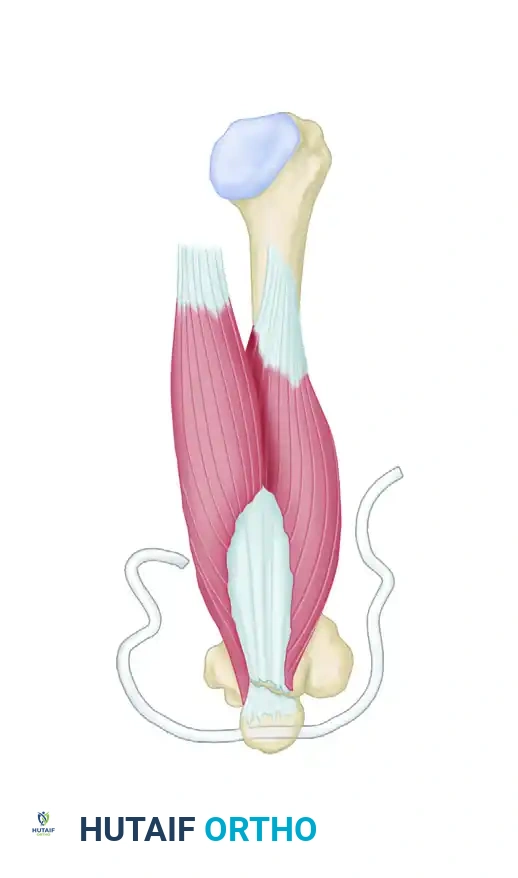 DISPLACEMENT OF TENDONS Surgical Diagram