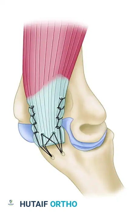 DISPLACEMENT OF TENDONS Surgical Diagram