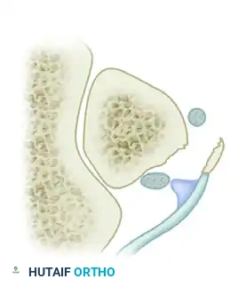 DISPLACEMENT OF TENDONS Surgical Diagram