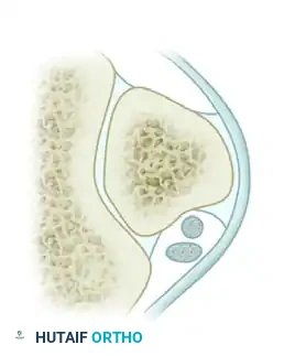 DISPLACEMENT OF TENDONS Surgical Diagram