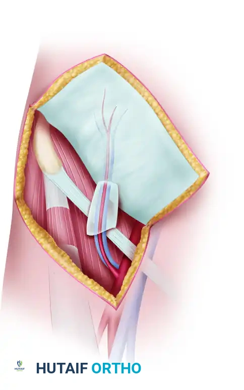 Mastering Free Tissue Transfer: Surgical Dissection of the Groin and Anterolateral Thigh Flaps
