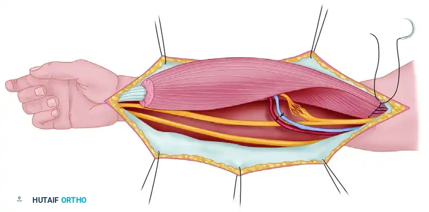 Pectoralis Major Transfer and Tensor Fasciae Latae Flap: Advanced Surgical Techniques