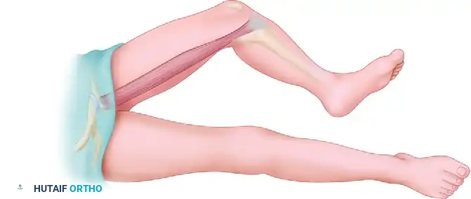 DISSECTION FOR TENSOR FASCIAE LATAE MUSCLE FLAP Surgical Diagram