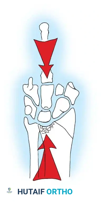 Fig. 55-32 Die-punch fracture of lunate facet may produce volarly tilted malunion similar to volar intercalated segment instability.