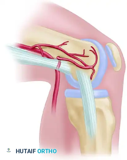 Vascularized Bone Grafting: Medial Femoral Condyle and Iliac Crest Flaps