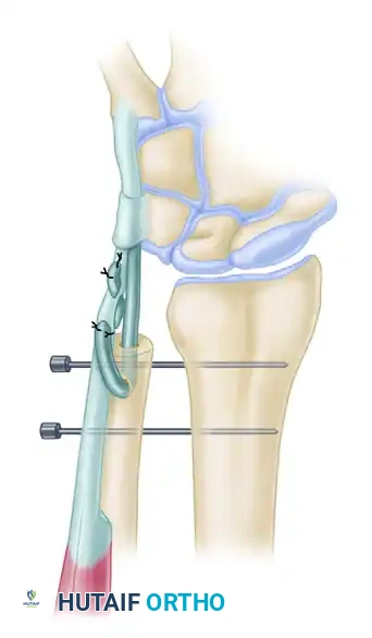 ECU Tenodesis to Ulna