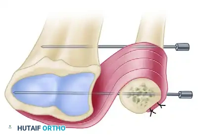 Pronator Quadratus Transfer