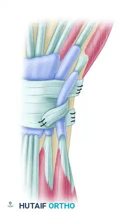 Palmar Skin Incision