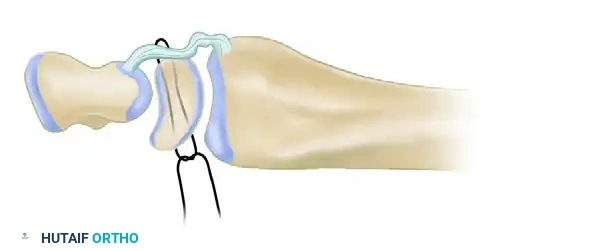 DORSAL CAPSULODESIS Surgical Diagram