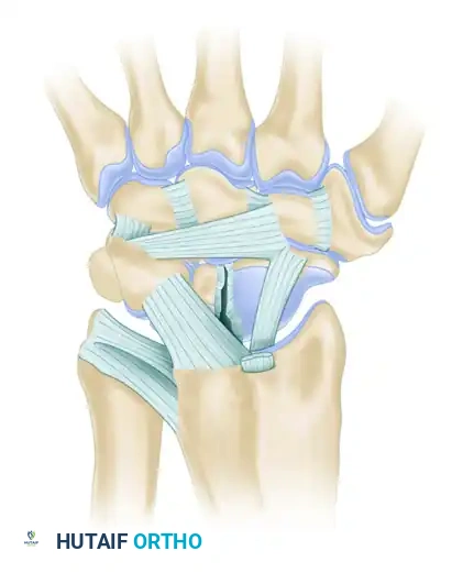 DORSAL CAPSULODESIS Surgical Diagram