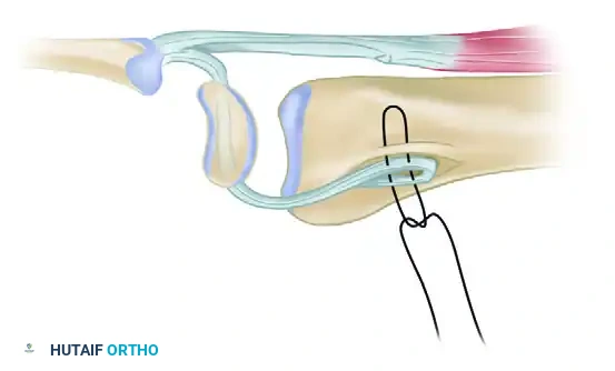 DORSAL CAPSULODESIS Surgical Diagram