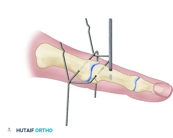 Dynamic Distraction External Fixation for PIP Joint Fracture-Dislocations
