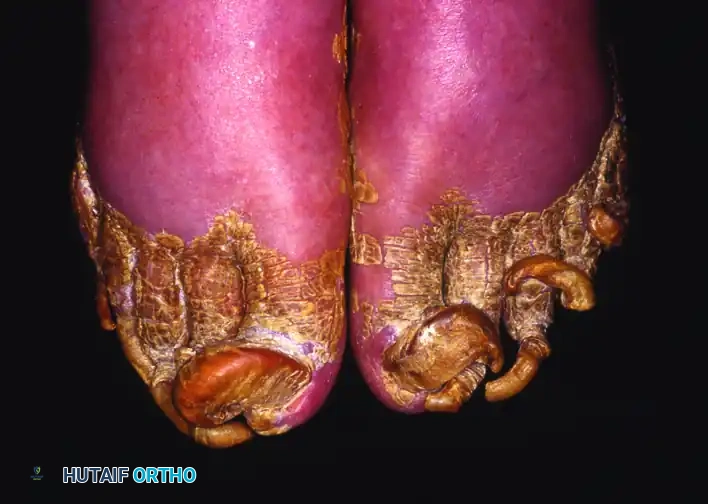 DYSTROPHIC NAILS (ONYCHOGRYPOSIS, ONYCHOMYCOSIS) Surgical Diagram